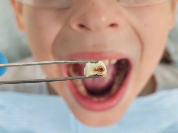 Best Emergency Wisdom Teeth Removal in Tornillo, TX