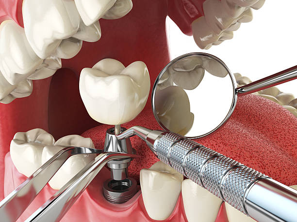 Best Emergency Treatment for Dental Infections or Abscesses in Tornillo, TX